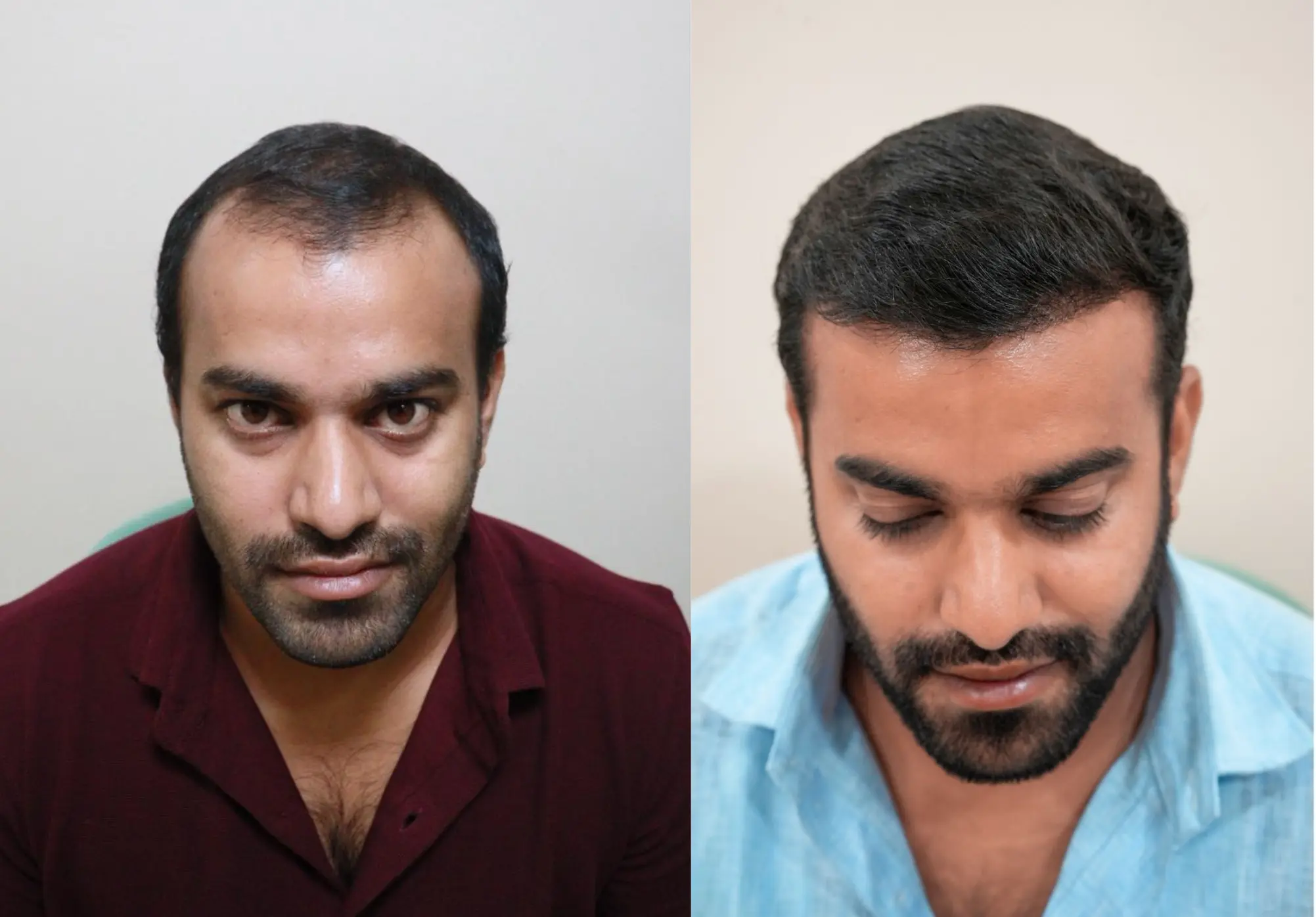 Hair Transplant Before and After Vizag